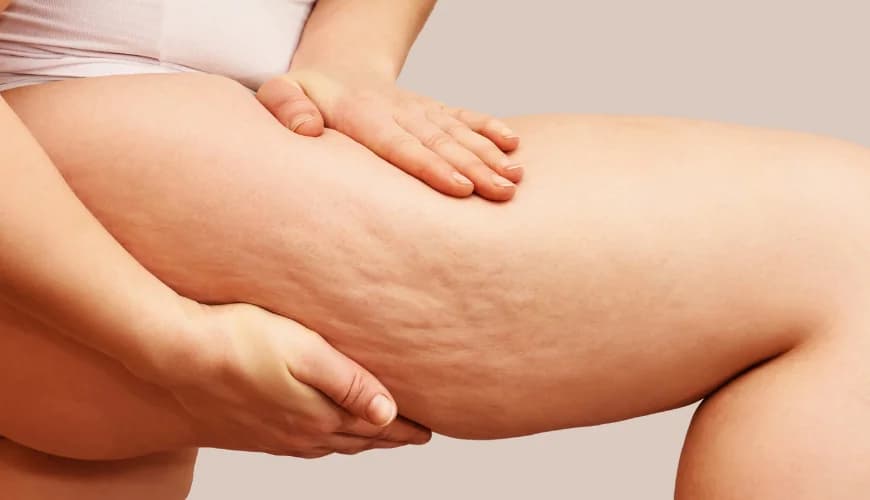 Lipödem-Symptome lindern: Praktische Tipps für den Alltag